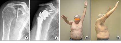 Reverse Total Shoulder Arthroplasty: Indications and.